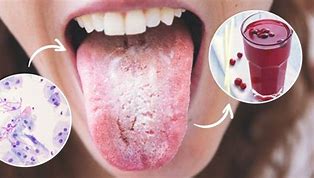 Image result for Candida Throat Infection