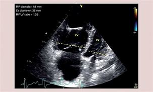 Image result for Ventricular Dilation