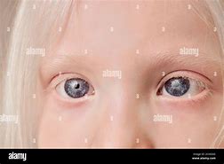 Image result for albino child eyes