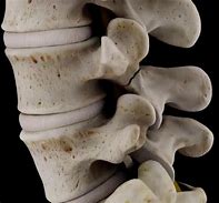 Image result for Pars Defect Lumbar Spine