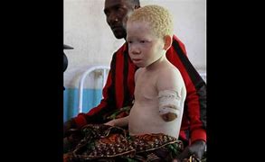 Image result for South African Albino Child