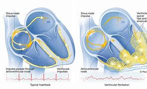 Image result for Ventricular Fibrillation Symptom