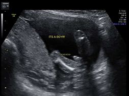 Image result for Baby Girl or Baby Boy Ultrasounds