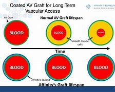 Image result for AV Graft