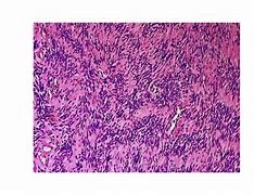 Image result for Vestibular Schwannoma Gross Pathology