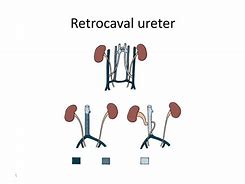 Image result for Postcaval Ureter