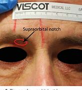 Image result for Dorsal Nasal Artery