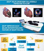 Image result for EECP Angina