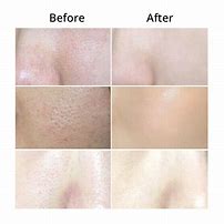 Image result for Hard Sebum in Pores