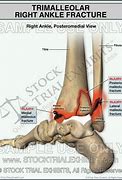 Image result for trimalleolar fracture x ray