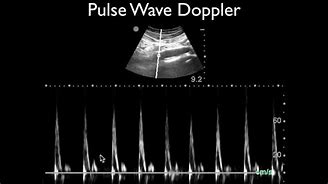 Image result for Pedal Pulse Doppler