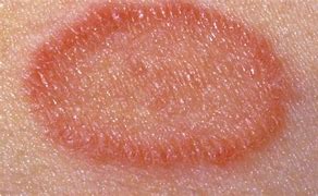 Image result for Dark Red Spots On Skin