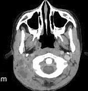 Image result for Sinus Thrombosis