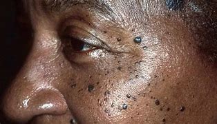 Image result for Flat Skin Warts