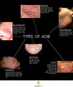 Image result for Acne On Side of Face