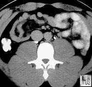 Image result for Retrocaval Ureter vs Normal