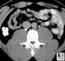 Image result for Retrocaval Surter Radiology