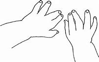 Image result for Trident Hand Achondroplasia