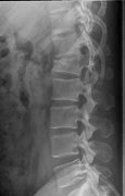 Image result for Imagees Compression Fracture of Lumbar Vertebrae