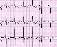 Image result for Right Heart Failure ECG