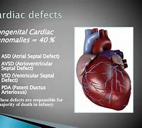 Image result for AV Canal Defect Down Syndrome