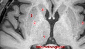 Image result for CT Brain Lentiform Nucleus