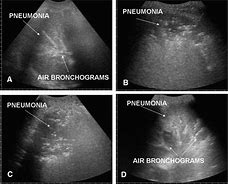 Image result for Lung Ultrasound Probe