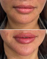 Image result for Chin Correction Filler