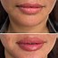 Image result for Chin Correction Filler