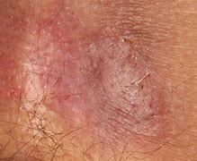 Image result for Herpes Genitalis