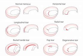 Image result for Meniscal Tear Treatments