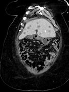 Image result for Spleen Metastasis