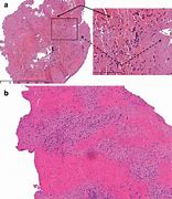 Image result for Thrombosis Histology