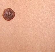 Image result for Benign Skin Bumps