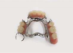 Image result for Metal-Based Partial Dentures