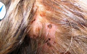 Image result for Build Up with Worms in Hair