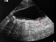 Image result for Cholecystectomy Ultrasound