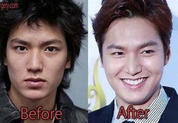 Image result for Lee Min Ki Plastic Surgery