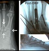 Image result for Lisfranc Orif