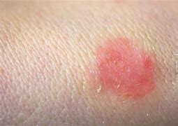 Image result for Small Red Circular Rash On Skin