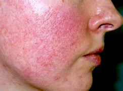 Image result for Mild Acne Rosacea