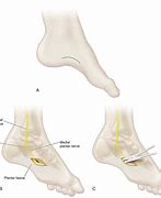 Image result for Plantar Fasciectomy