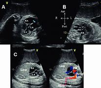 Image result for Right Atrial Appendage Fetal Echo