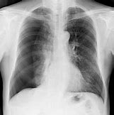 Image result for Signs of Collapsed Lung