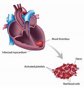 Image result for Sessile Thrombus