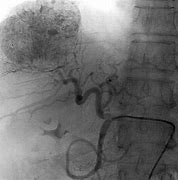 Image result for Tace Ablation