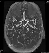 Image result for MRI Angiography