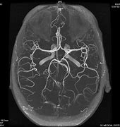 Image result for Normal MRI Angio