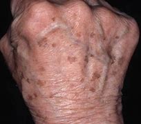 Image result for Dark Age Spots On Legs