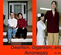 Image result for Gigantism Acromegaly and Dwarfism